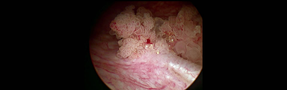 Cystoscopic view of a small superficial bladder tumour.